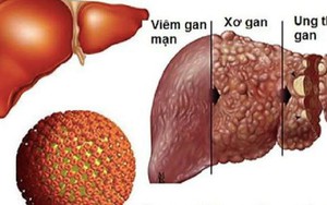 Khoảng 8,8 triệu người Việt bị căn bệnh 'diễn biến thầm lặng nhưng hậu quả rất nghiêm trọng'