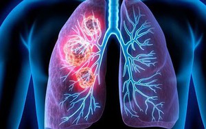 2 vợ chồng cùng mắc ung thư phổi: Bác sĩ chỉ ra nguyên nhân