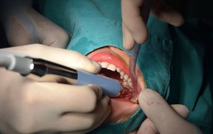 Áp xe vùng mặt - Hậu quả nặng nề khi chủ quan với biến chứng mọc răng khôn