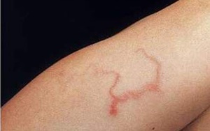 Người suy kiệt, sút cân, tưởng ung thư hoá ra do nhiễm loại ký sinh trùng phổ biến tại VN
