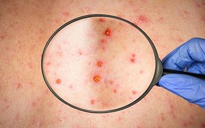 5 câu hỏi thường gặp về bệnh đậu mùa khỉ