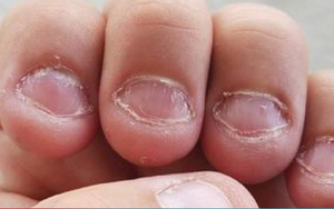 Thói quen cắn móng tay và những ẩn họa khôn lường