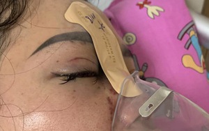 Mù mắt vì tiêm filler nâng mũi tại spa