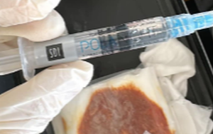 Tiêm filler trị thâm, nữ khách hàng bị tiêm ôxy già vào mắt
