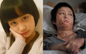 Khúc mắc tình cảm với thiếu gia nhà giàu, cô gái 16 tuổi bị "hủy dung": Hành trình sống tiếp khó như lên trời