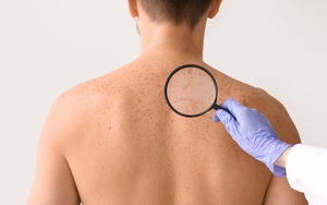 Người đàn ông phát hiện ung thư kịp thời nhờ vợ 'chỉ điểm' 2 dấu hiệu lạ trên lưng