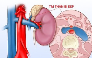 3 năm đau bụng không tìm được nguyên nhân: BS cảnh báo hội chứng gặp ở người bụng phẳng