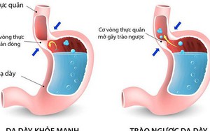 Bệnh trào ngược dạ dày - thực quản: 5 biến chứng nguy hiểm