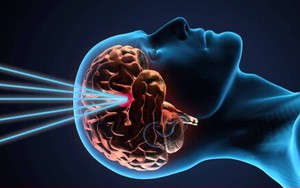 Dấu hiệu u não ác tính