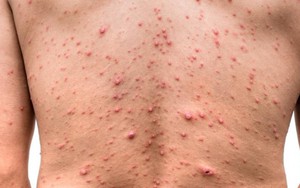 Số ca thủy đậu ở Hà Nội tăng cao, chuyên gia chỉ cách phòng tránh