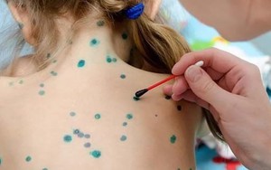 Bệnh thủy đậu bùng phát mạnh tại Hà Nội, sắp chạm ngưỡng 1.000 ca: Làm gì để phòng tránh?
