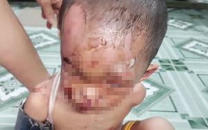 Nghi vấn bé trai ở TPHCM bị cha mẹ đánh đập dã man, trên người đầy vết thương