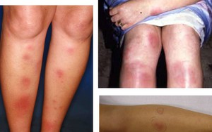 Căn bệnh hay gặp ở các chị em 20-30 tuổi khiến da sẩn cục, nóng đỏ