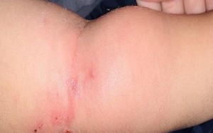 Bé 2 tuổi nhiễm trùng máu từ vết muỗi đốt