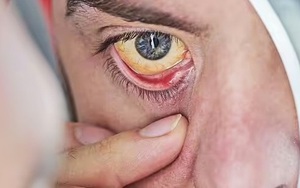 Bác sĩ lên truyền hình, cảnh báo 2 dấu hiệu ở mắt có thể ‘gióng lên hồi chuông cảnh báo’ bệnh tật