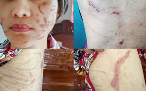 Công an điều tra vụ người vợ bầu 7 tháng tố bị chồng bạo hành dã man như thời trung cổ