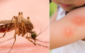 Mẹo hay giúp giảm ngứa khi bị muỗi đốt