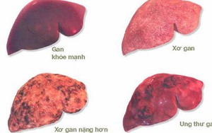 Chuyên gia ung bướu chỉ ra 8 yếu tố nguy cơ dẫn đến ung thư gan