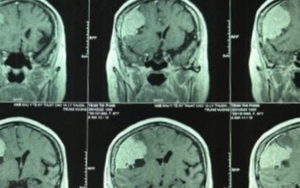 Đi khám đau đầu, phát hiện khối u màng não to hơn trứng vịt