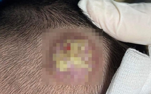 Thường xuyên ngủ chung với chó, mèo, 2 thành viên trong gia đình bị bệnh lạ ở vùng da đầu