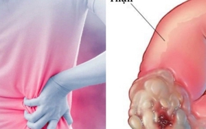 5 dấu hiệu cảnh báo ung thư thận không nên bỏ qua