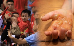 Từ vụ bé trai bị bỏng do pháo sáng trên sân Hàng Đẫy: Bác sĩ lưu ý khi xử trí vết bỏng