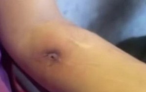 Thực hư chuyện hàng chục chiếc đinh 'mọc' ra từ cánh tay người phụ nữ ở Quảng Ngãi