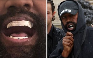 Kanye West gây sốc khi nhổ hết răng thật