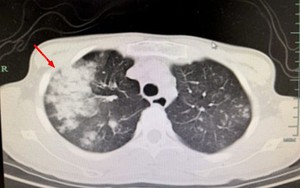 Thanh niên 20 tuổi sốt cao, đi khám phát hiện phổi trắng xóa: Tác nhân gây bệnh quen thuộc đến bất ngờ