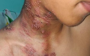 Cứ 3 người thì có 1 người nguy cơ mắc căn bệnh đau đớn này