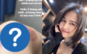 Sau 1 tháng điều trị, Ngọc Trinh tiết lộ hình ảnh vết thương do tai nạn khi "diễn xiếc" trên mô tô để lại