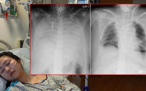 Chụp X-quang phát hiện nhiều người trẻ phổi trắng xóa, nguyên nhân vì đâu?
