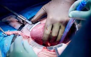 Đột phá: Người phụ nữ đầu tiên được ghép thận lợn và tim nhân tạo cùng lúc