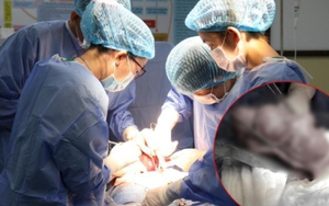 Người phụ nữ ở Bạc Liêu bỗng đau bụng dữ dội, phẫu thuật lấy ra được một thứ nặng đến 900 gram