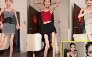 Bị gọi là Bạch Cốt Tinh do quá gầy, cô gái nặng 25kg vẫn muốn giảm cân