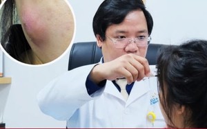 Suýt hoại tử mặt do tự ý nặn mụn