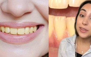Chăm sóc răng rất kỹ nhưng vẫn ố vàng, nha sĩ chỉ ra 2 sai lầm hầu như ai cũng mắc: Cần nhớ 2 thời điểm KHÔNG NÊN đánh răng