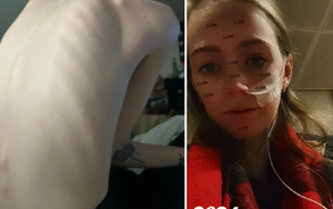 Cô gái 25 tuổi "nôn 60 lần/ngày, phải đứng ăn để không chết ngạt" vì...