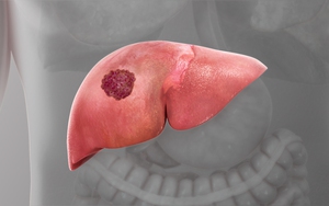 Đây là 6 triệu chứng sớm nhất của ung thư gan: Nhiều người không biết nên bỏ qua