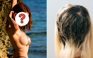 Nữ DJ suy sụp bật khóc, tóc rụng mảng lớn