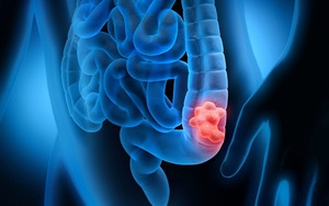 Cảnh báo: Yếu tố này khiến một người gần như chắc chắn mắc ung thư đại tràng nếu không được phát hiện