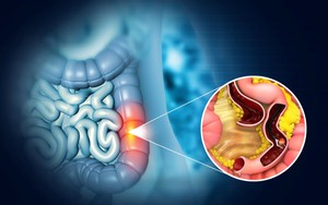 Ung thư đại tràng thường ‘rình rập’ những người có đặc điểm này trên cơ thể