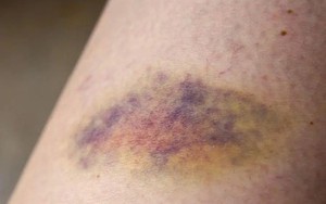 1 dấu hiệu trên da có thể cảnh báo ung thư "cận kề": Bác sĩ khuyên nếu thấy nên đi khám ngay