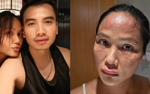 Hoa hậu H'Hen Niê sau khi bị biến dạng mặt