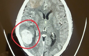 Phát hiện dấu hiệu lạ ở mặt khi đi chợ sớm, bệnh nhân làm ngay 1 việc khiến bác sĩ khen “quá sáng suốt”