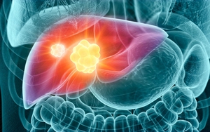 Những triệu chứng sớm nhất của ung thư gan - biết rõ sẽ "cứu mạng"