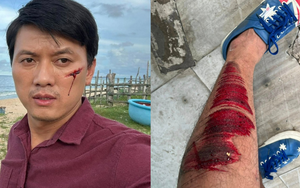 Quách Ngọc Tuyên bị tai nạn