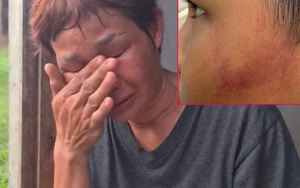 Bé trai 7 tuổi bị cô giáo dùng thước sắt đánh 14 lần vì ăn một viên kẹo