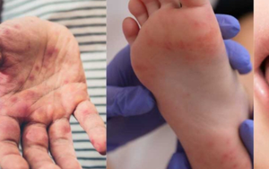 Bệnh tay chân miệng ở trẻ em: Dấu hiệu, nguyên nhân và cách điều trị