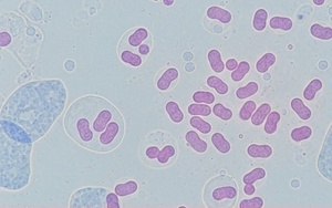 Hà Nội ghi nhận ca mắc não mô cầu là trẻ 11 tuổi, chưa tiêm vaccine